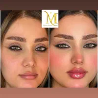 تزریق ژل بوتاکس فول فیس ۶۸۰۰نخ توسط پزشک در کلینیک