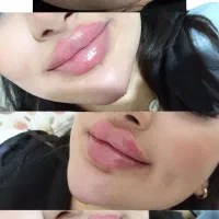 تزریق ژل وبوتاکس وساکشن غبغب