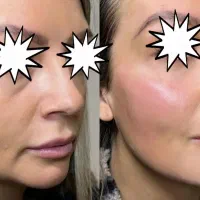 جشنواره پاییزه تزریق ژل و بوتاکس|خدمات آرایشگری و زیبایی|اصفهان, رزمندگان|دیوار