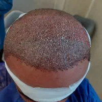 موهای طبیعی با جدیدترین تکنولوژی کاشت مو در شیراز|خدمات آرایشگری و زیبایی|اصفهان, ارداجی|دیوار