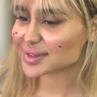 تزریق ژل بوتاکس و چربی شکم پهلو|خدمات آرایشگری و زیبایی|کرمانشاه, |دیوار