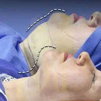 لیپو ساکشن غبغب۶۹۰۰ تخلیه چربی شکم و پهلو ۱۹میلیون|خدمات آرایشگری و زیبایی|اصفهان, احمدآباد|دیوار