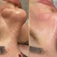فیشیال پاکسازی صورت