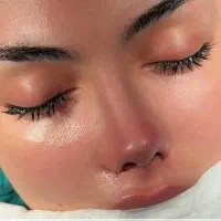 جراحی زیبایی بینی / عمل بینی/ رینوپلاستی