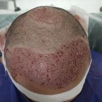 آموزش کاشت مو