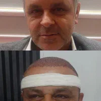 کاشت تخصصی ابرو وموتضمینی بدون جراحی قیمت استثنایی|خدمات آرایشگری و زیبایی|تبریز, |دیوار