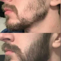 رازه پرپشتیه ریش