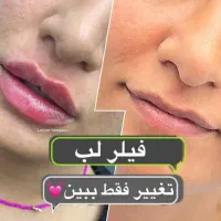 تخفیف جشنواره ای فیلر لب و مزو جاپرو و سوپرهیدرو