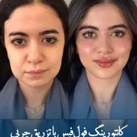 ژل بوتاکس ژل لب فیلر بادی نخ لیفت فیلر زیر چشم|خدمات آرایشگری و زیبایی|اصفهان, جلفا|دیوار