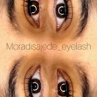 تخفیف ویژه /کاشت هیدن به مدت یک هفته