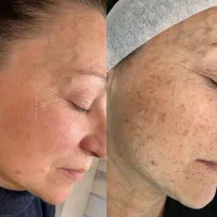 درمان تضمینی لک و کک و مک و خال /فقط در 1 جلسه|خدمات آرایشگری و زیبایی|اصفهان, لاله|دیوار