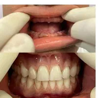 دندان مصنوعی(بدون واسطه خرید کن)