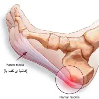 مرکز ارتوز درمان خارپاشنه