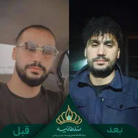کاشت مو پرتراکم با طراحی خط رویش مو