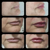 آموزش فیلر &بوتاکس