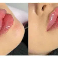 مدل ژل لب گونه چونه زاویه خط خنده ۴۰۰ ت|خدمات آرایشگری و زیبایی|قم, تولید دارو و یخچال|دیوار