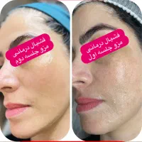 مزودرمانی/لک و جای جوش /تخفیف ویژه