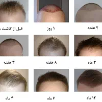 کاشت مو وزیبایی بدن اقساطی|خدمات آرایشگری و زیبایی|تبریز, |دیوار