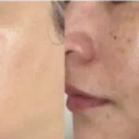 پاک کردن تاتو بدن رفع لک و خال
