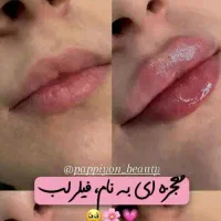 کربنتراپی بوتاکس  فیلر PRP و لیزر در کلینیک