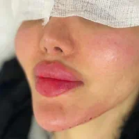 جشنواره تزریق ژل بوتاکس پی آر پی توسط پزشک|خدمات آرایشگری و زیبایی|کرمانشاه, |دیوار