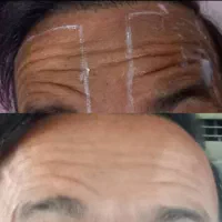 هایفو تراپی پوست لیفت و جوان سازی پوست درگتوند
