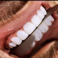 جشنواره کامپوزیت دندان فکی۱۶م تومان vipبرای زیباجو