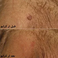 درمان زگیل پوستی/کرایو تراپی و لیزر/hpv|خدمات آرایشگری و زیبایی|اهواز, کیانپارس |دیوار
