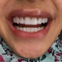 ایمپلنت کره ای با روکش رایگان + کرج 16900|خدمات زیبایی و سلامت|کرج, فاز ۲ مهرشهر|دیوار