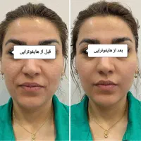 هایفو(لیفت صورت در یک جلسه)تخفیف ۵۰ درصدی|خدمات آرایشگری و زیبایی|مشهد, وکیل‌آباد|دیوار