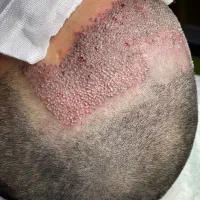 کیلینیک کاشتمو خانم هلیلی|خدمات آرایشگری و زیبایی|اهواز, زیتون کارمندی|دیوار