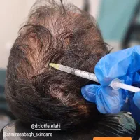 مزوتراپی مو ، ابرو ، جوانسازی ، فیشیال ، پاکسازی|خدمات آرایشگری و زیبایی|کرج, جهان‌شهر|دیوار