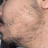 ریش تراپی