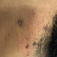 برداشتن خال/زگیل/منگوله های پوستی**|خدمات آرایشگری و زیبایی|اصفهان, مرداویج|دیوار