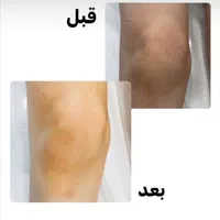 تخفیف لیزر اشنایدرپلاس و روشن سازی نواحی تیره|خدمات آرایشگری و زیبایی|بندرعباس, |دیوار