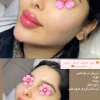 تزریق ژل وجوانسازی تخصصی ومزو ژل،بوتاکس|خدمات آرایشگری و زیبایی|شاهین‌شهر, فردوسی|دیوار