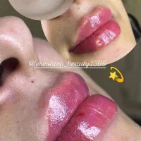 تزریق فیلر،بوتاکس ، فیلربیکینی باسن جوانسازولیزر