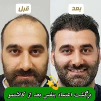 کاشت مو تضمینی و اقساطی در محیطی کاملا vip|خدمات آرایشگری و زیبایی|یزد, |دیوار