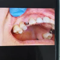 مرکزفوق تخصصی ایمپلنت دیجیتال/سبک کاخ لبخند/یکروزه|خدمات زیبایی و سلامت|مشهد, احمدآباد|دیوار