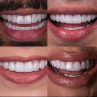 اقساطی کامپوزیت دندان روکش سرامیکی ایمپلنت لمینت