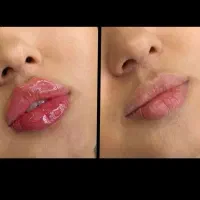 فیلر بادی(هیپ دیپ،بیکینی،ساق)محصولات سفیدکردن پوست|خدمات آرایشگری و زیبایی|بندر ماهشهر, |دیوار