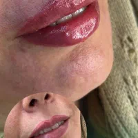 تزریق فیلر، بوتاکس، مزوتراپی، پی آر پی، مزونیدلینگ