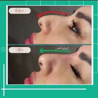 تخفیف ژل لب و بوتاکس فیلر مزو دکتر کاظمی|خدمات آرایشگری و زیبایی|مشهد, کوثر|دیوار