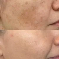 تخفیف ویژه کلینیک زیبایی درمانی پوست