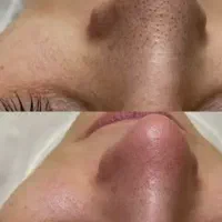 آف یلدایی فیشیال صورت