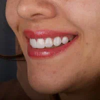 لمینت دندان و کامپوزیت تخصصی اقساطی کاملا دیجیتال