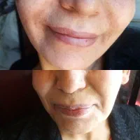 تزریق بوتاکس و ژل تضمینی