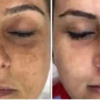 روشن کننده صورت وبدن ورفع تتو دستگاه پیکوشور تخفیف