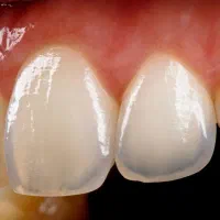 قسطی لب شیشه لیرینگ لمینیت جدید متفاوت دندان زیبا|خدمات آرایشگری و زیبایی|مشهد, سجاد شهر|دیوار