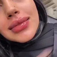 تزریق ژل لب .زاویه فک . بوتاکس. فیلر چانه.|خدمات آرایشگری و زیبایی|تهران, تهرانپارس غربی|دیوار